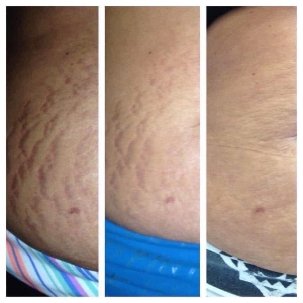 Stretch Mark Removal Soap - 150g - Image 2