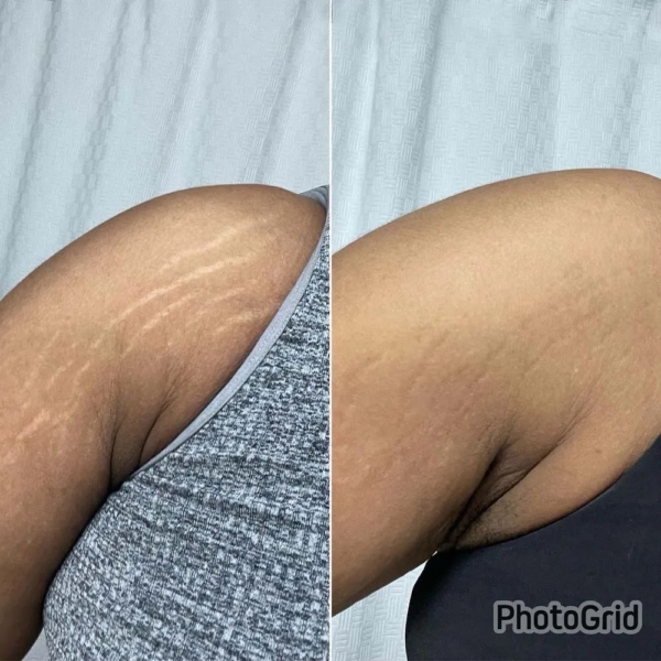 Stretch Mark Removal Oil - 30ml - Image 2